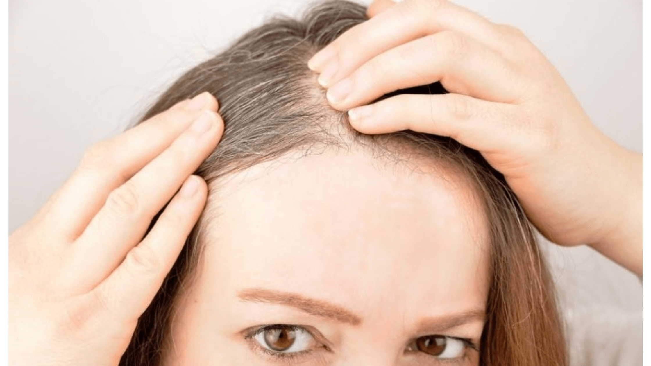 Hair Loss With White Bulb Immer Organic Hair Expert
